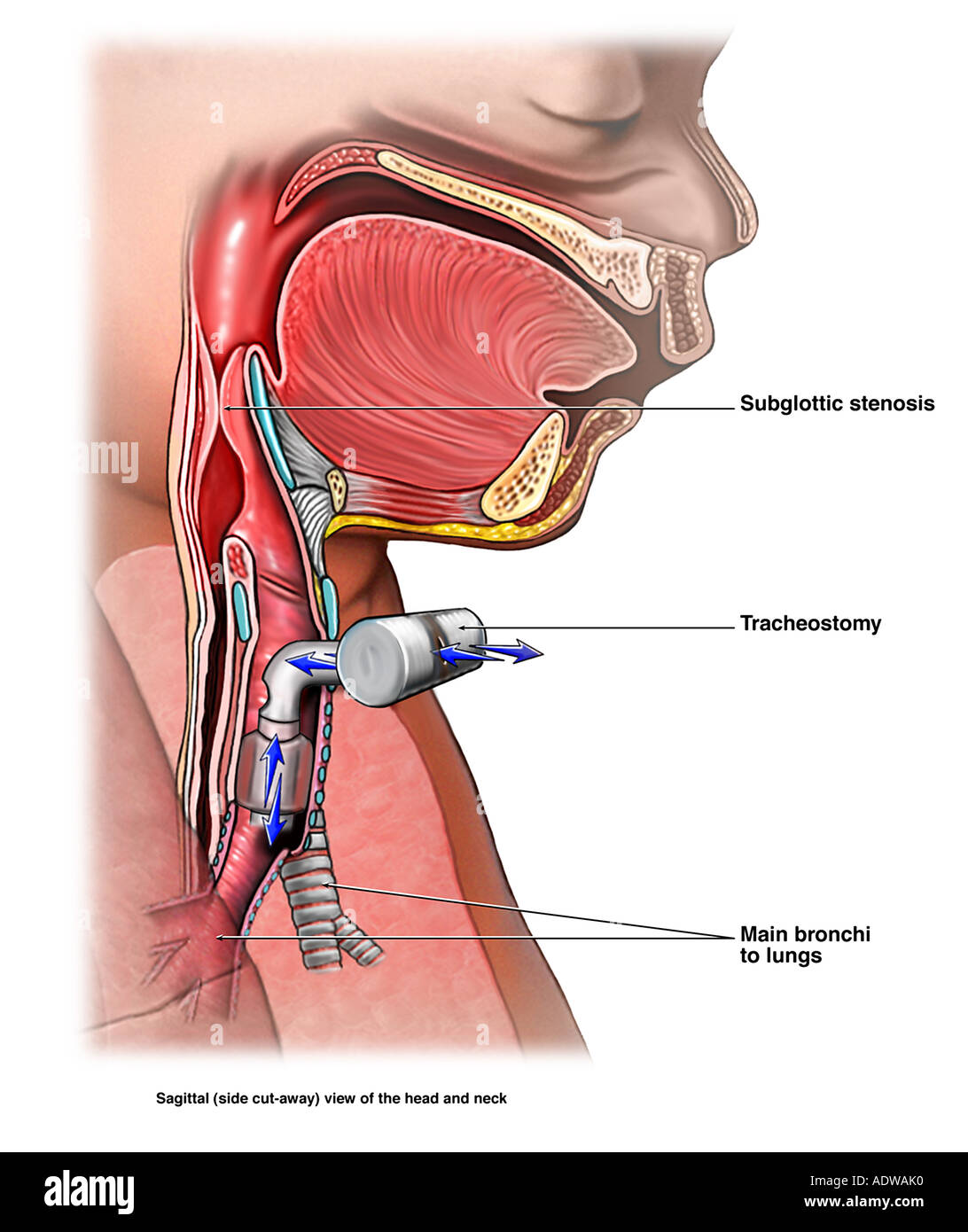 Placement of Tracheostomy Tube in Child with Subglottal Stenosis Stock