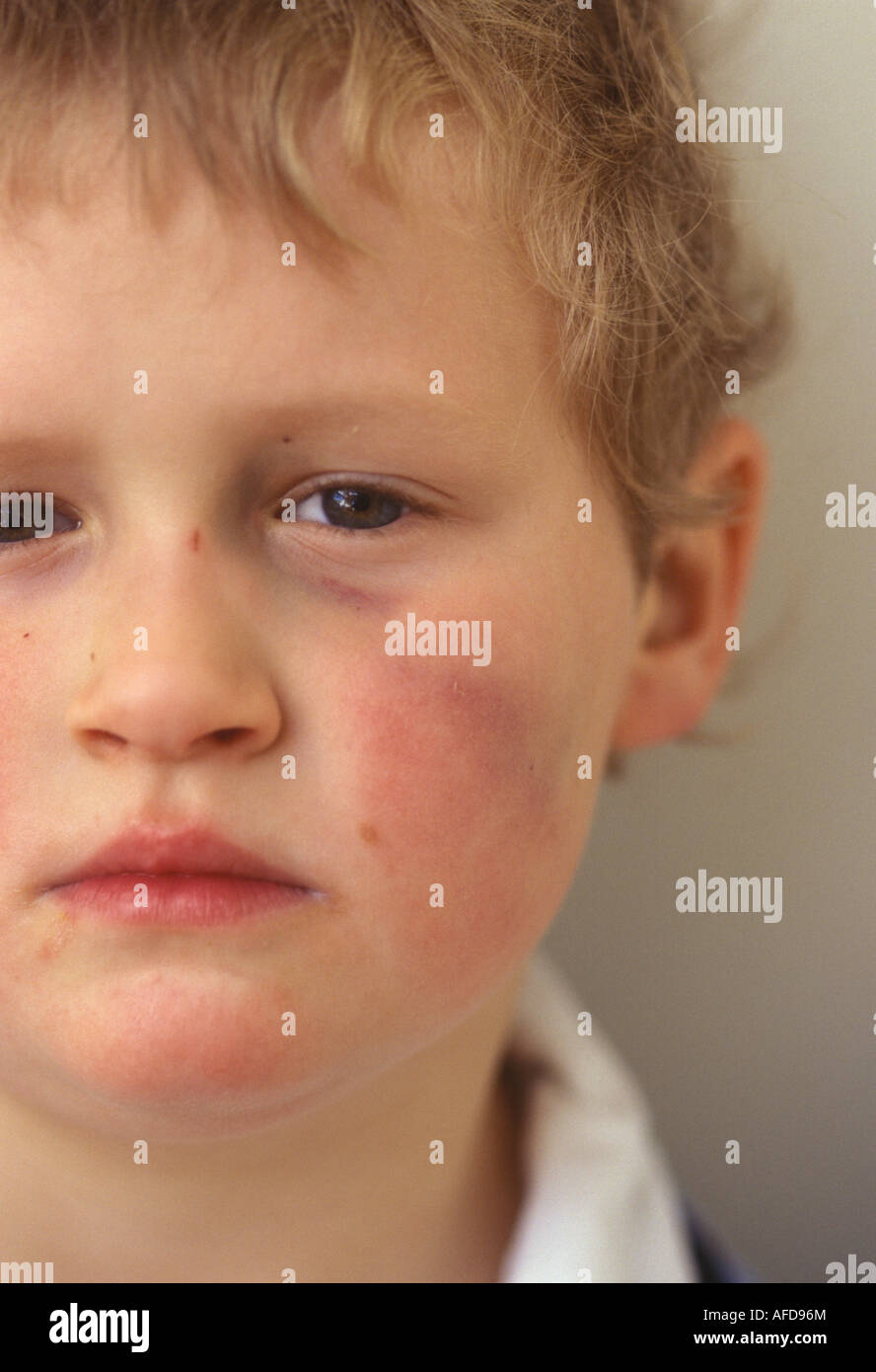 child with a bruised face and black eye Stock Photo, Royalty Free Image