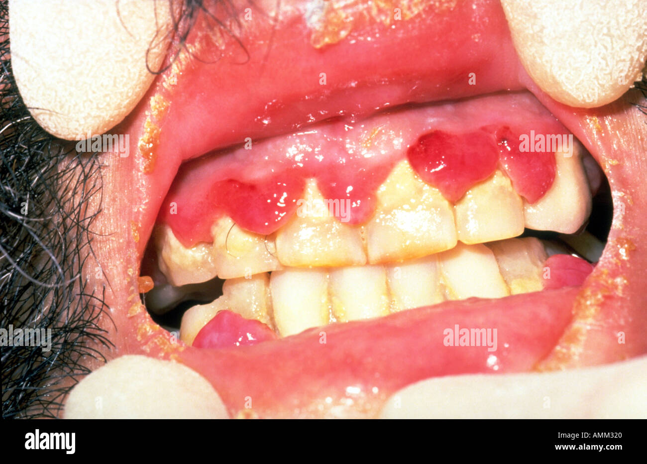 download a colour atlas of burn injuries chapman