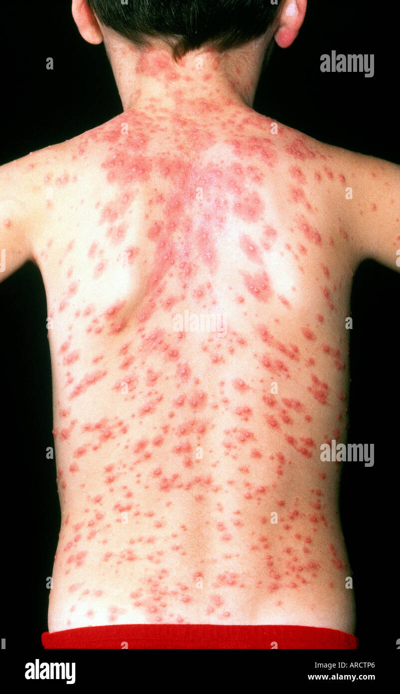 Chickenpox is a highly contagious illness that is common ...