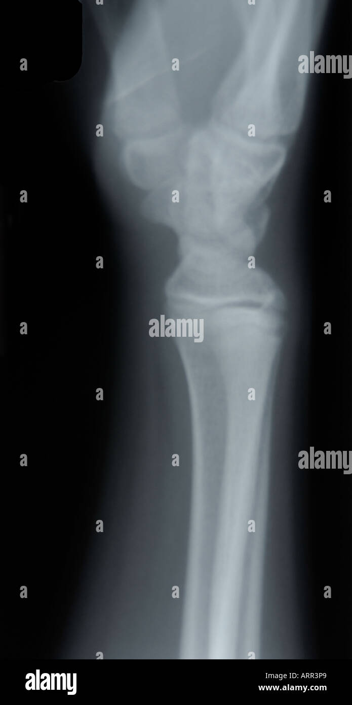 pediatric wrist x ray lateral view