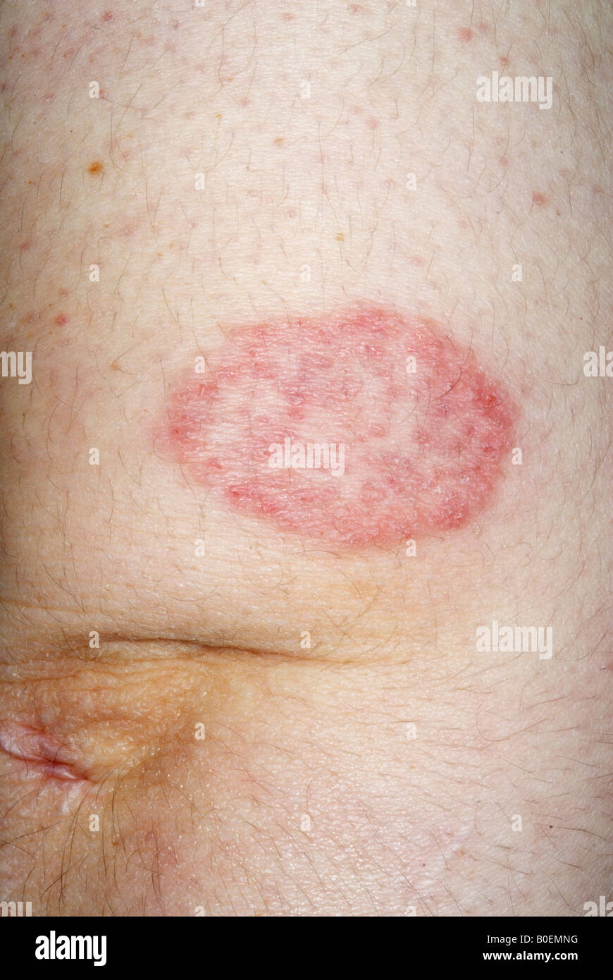ringworm fungus infection of the skin Stock Photo, Royalty Free Image