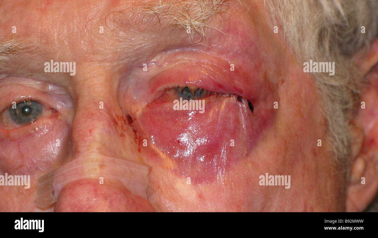 eye-injury-on-old-man-after-violent-attack-B92MWW.jpg