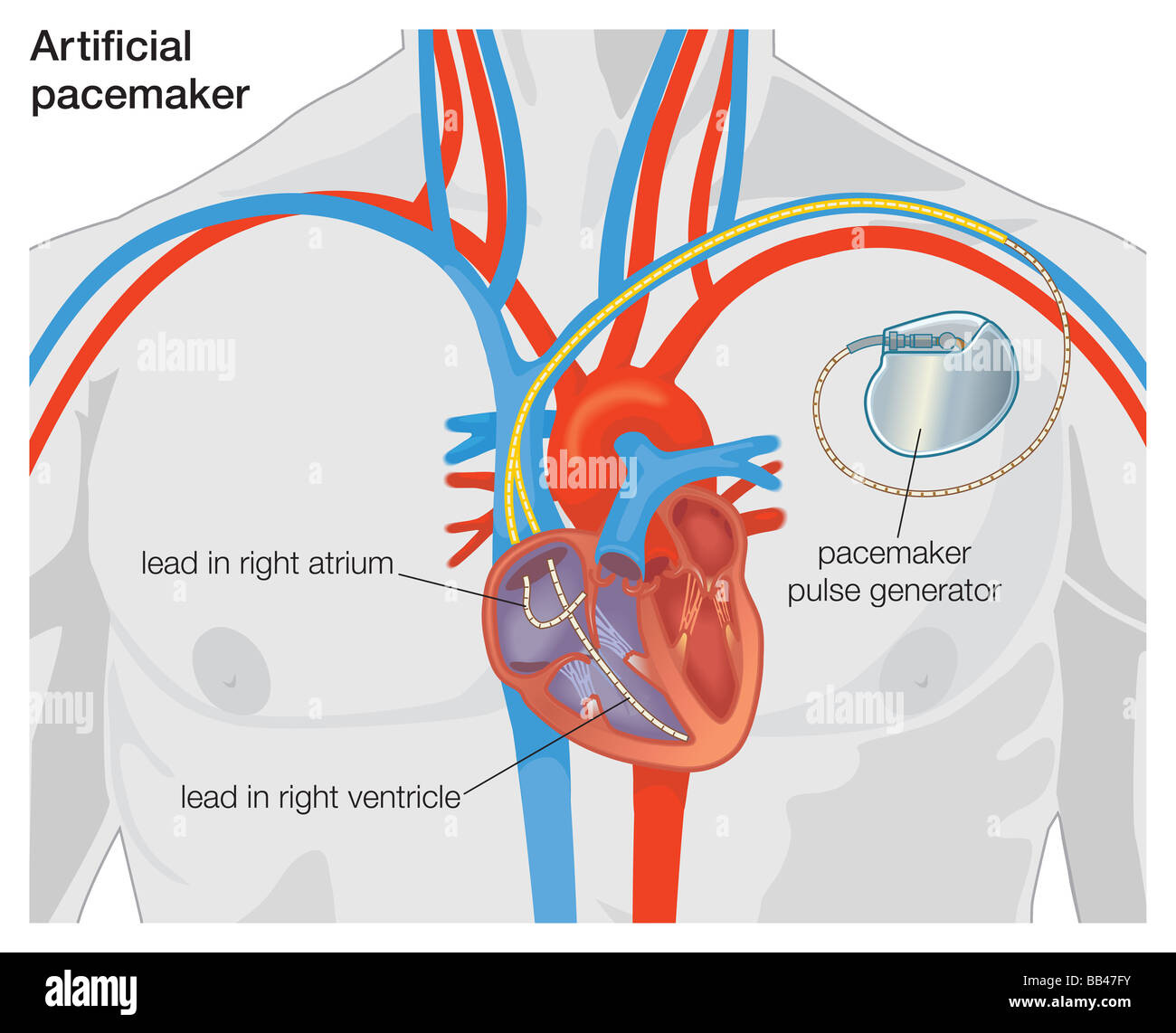 Diagram Of An Artificial Pacemaker Stock Photo Royalty Free Image