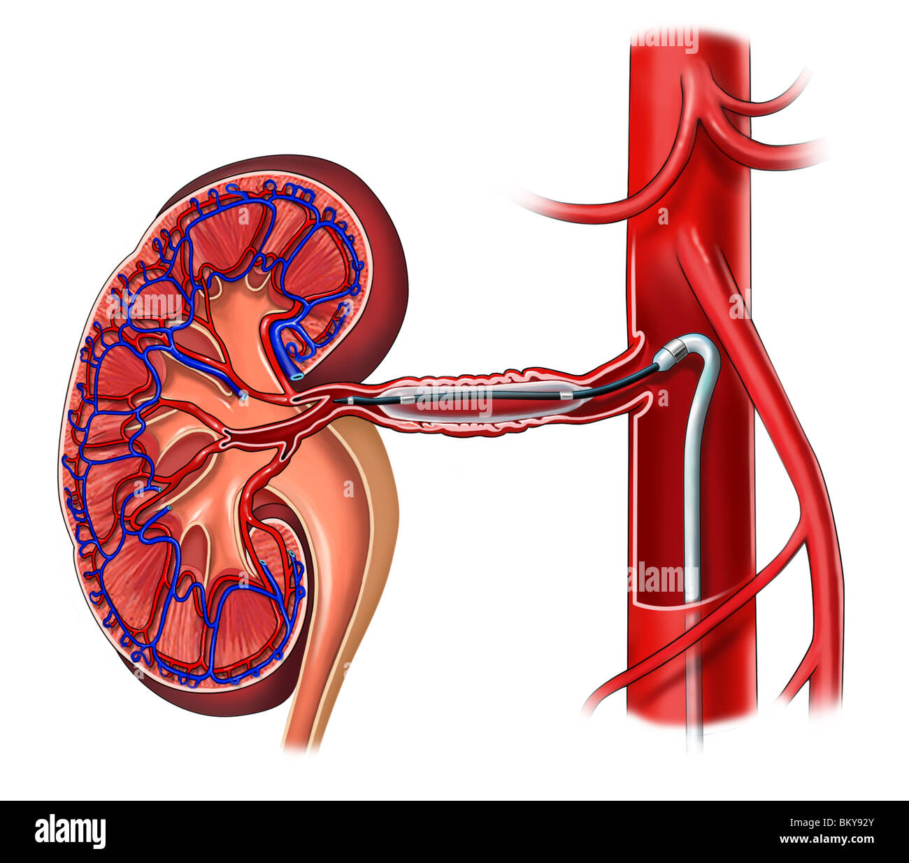 Angioplasty Of Renal Artery With Fibromuscular Dysplacia Stock Photo