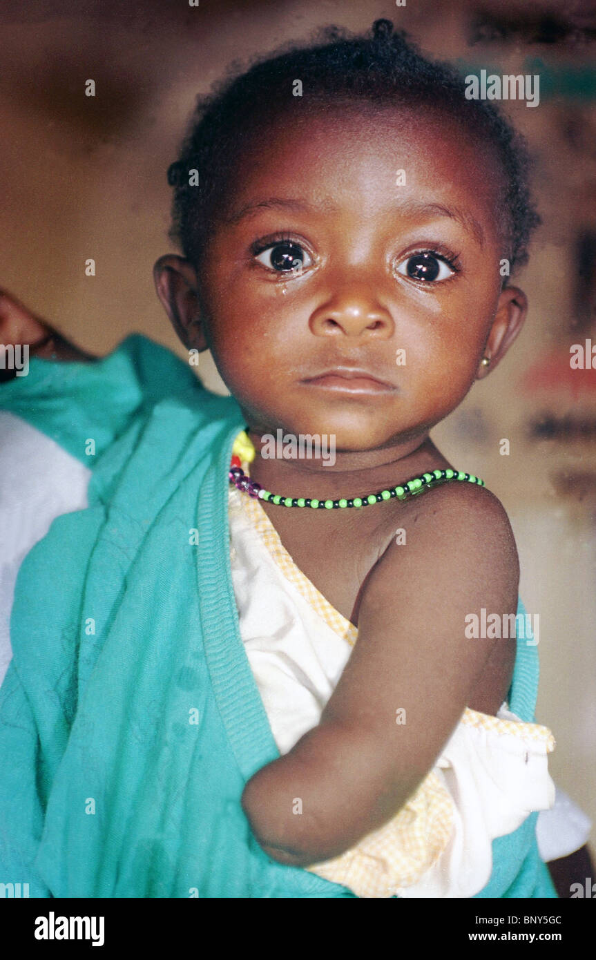 Baby amputee in Freetown, Sierra Leone. Her hands were amputated by the ...