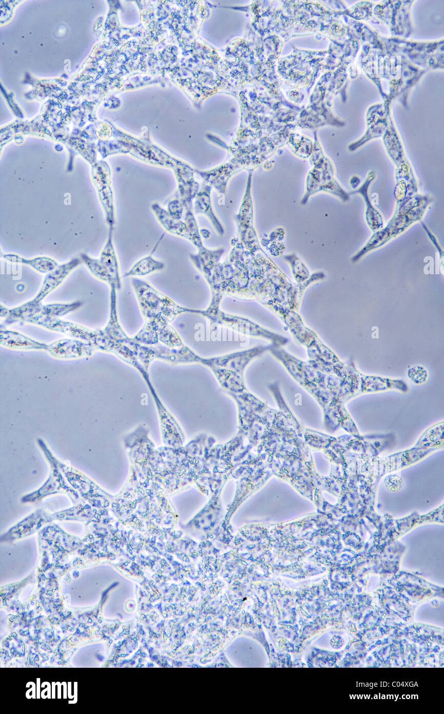 microscope-view-of-prostate-cancer-cells