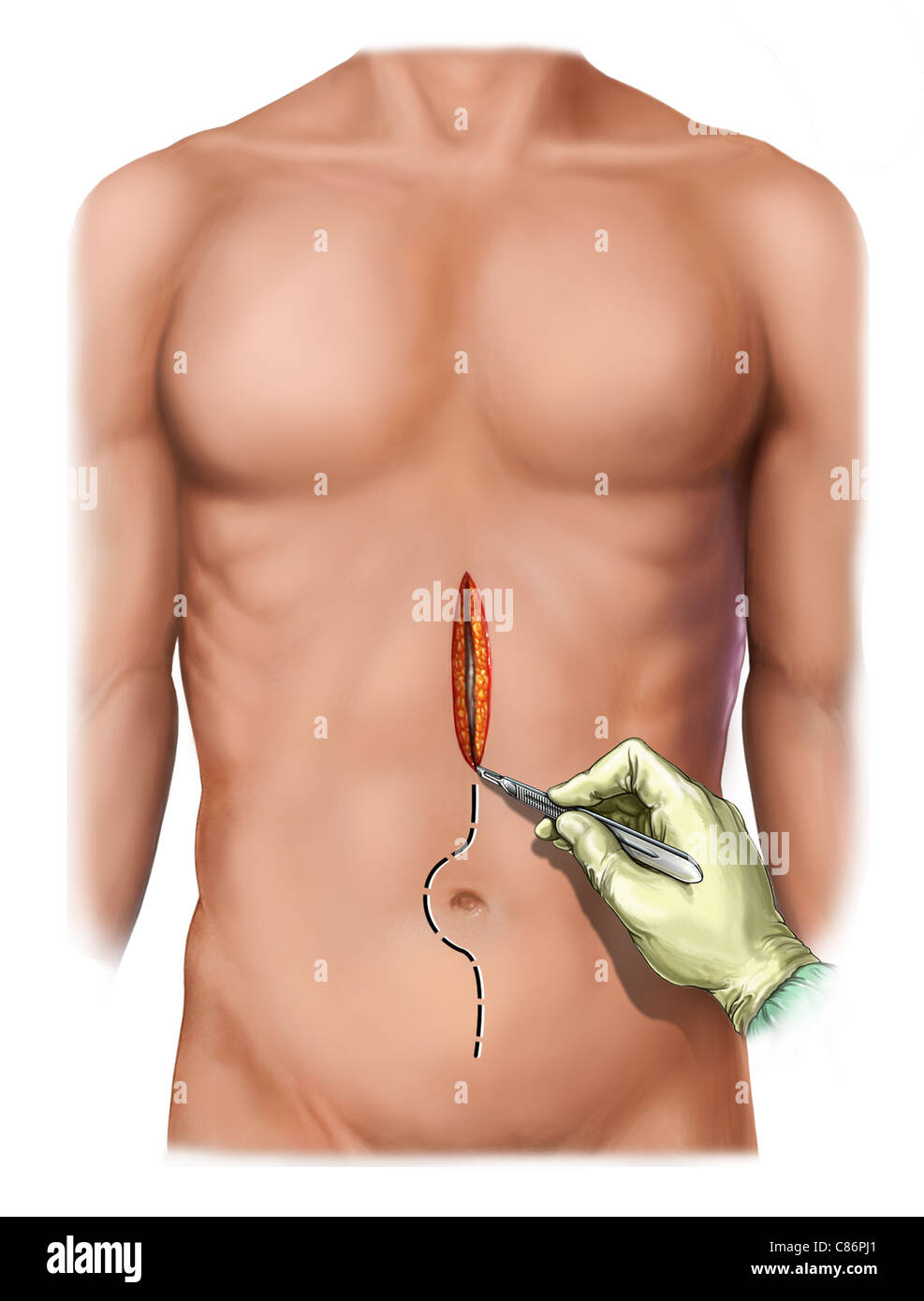 abdominal-midline-incision-C86PJ1.jpg
