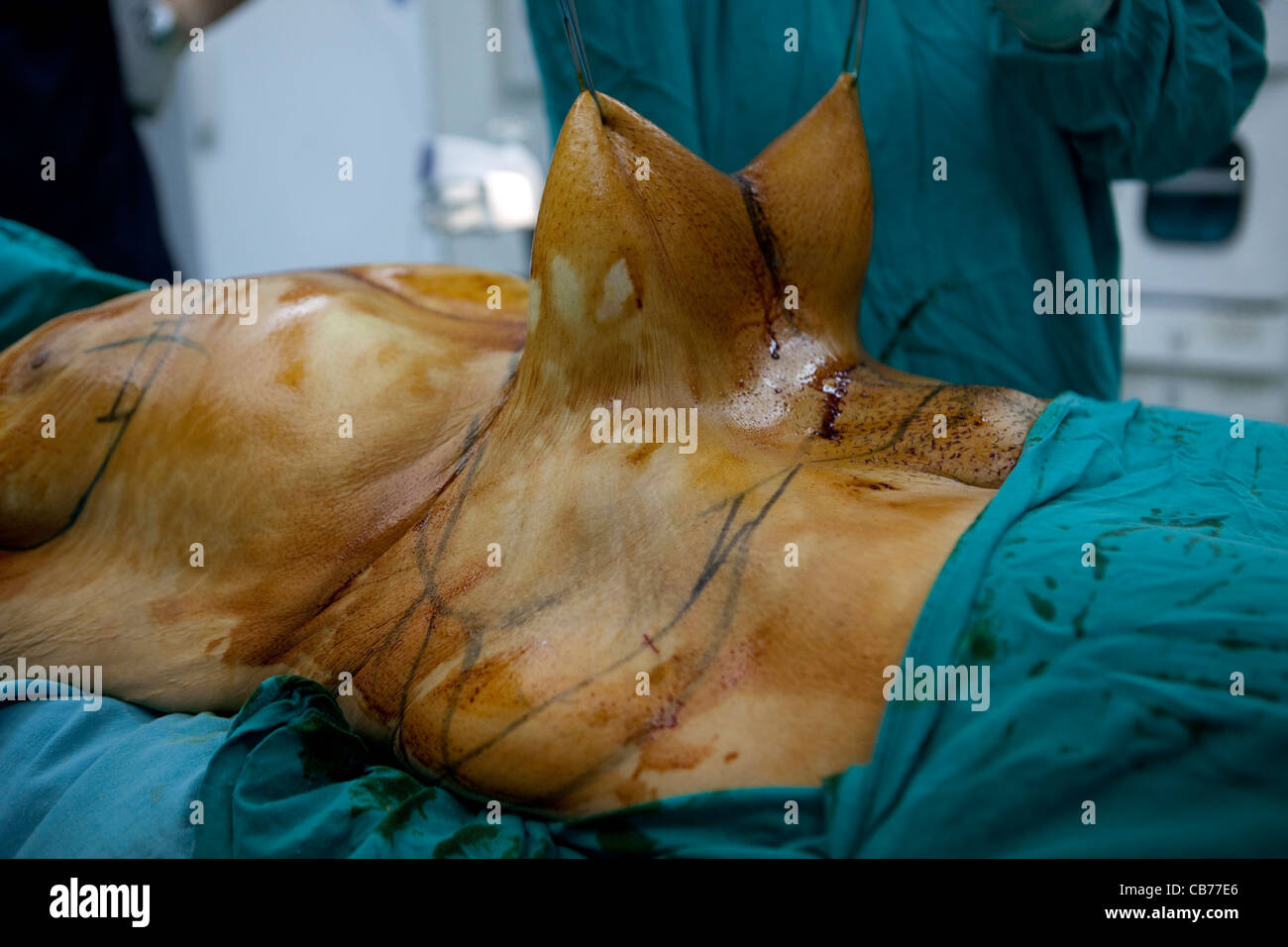 liposuction egypt liposuction egypt