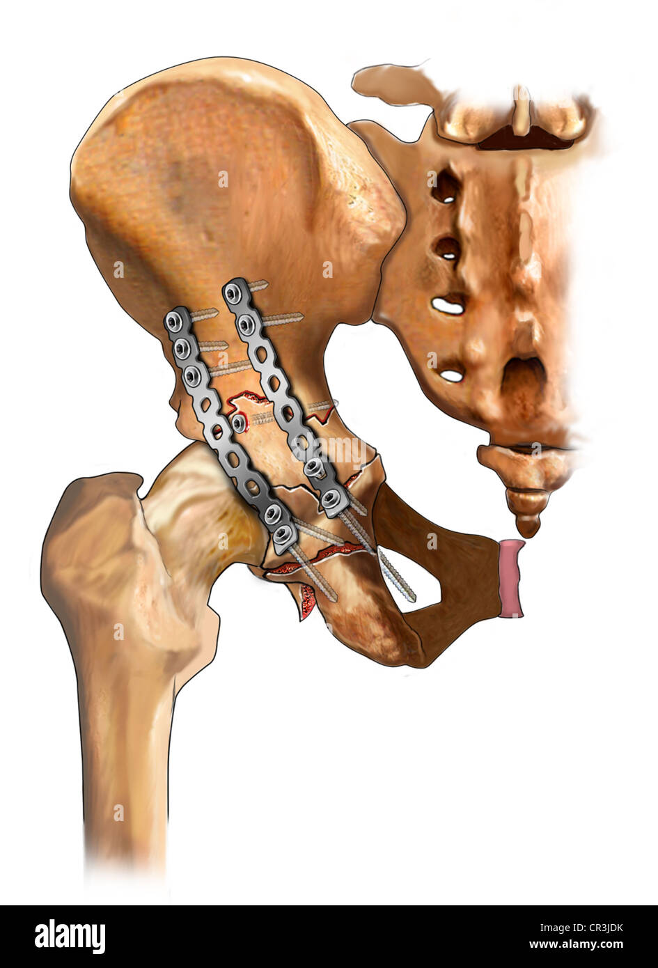 Posterior Acetabular Fracture Fixation Stock Photo, Royalty Free Image