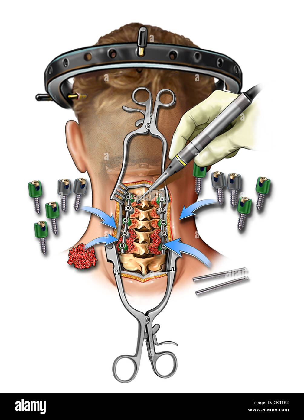 c3-7-posterior-cervical-bone-fusion-stock-photo-royalty-free-image