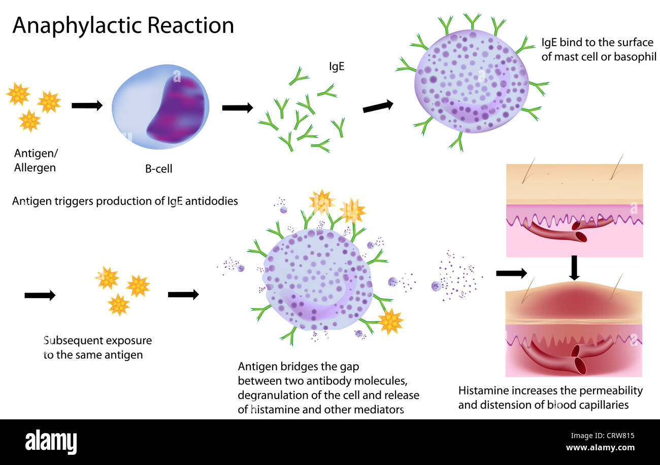 Mechanism of allergy (drug, hay fever, asthma,..), anaphylactic Stock