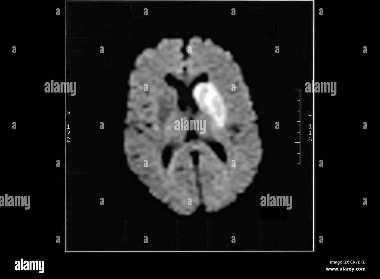 CEREBROVASCULAR DISEASE, MRI Stock Photo, Royalty Free Image 49159698