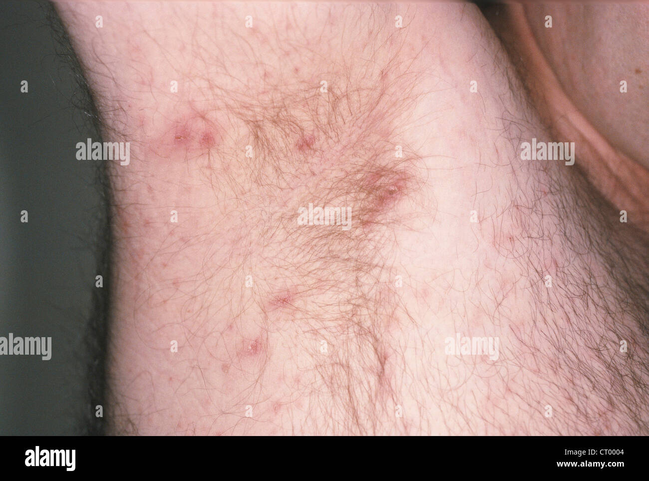 Scabies Hi Res Stock Photography And Images Alamy