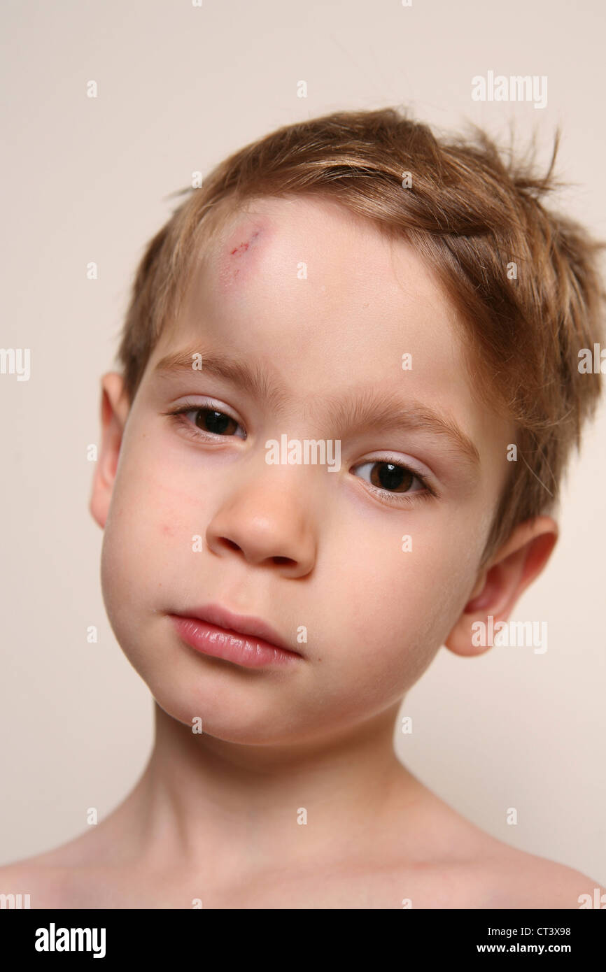 CHILD WITH HEMATOMA Stock Photo, Royalty Free Image 49258980 Alamy