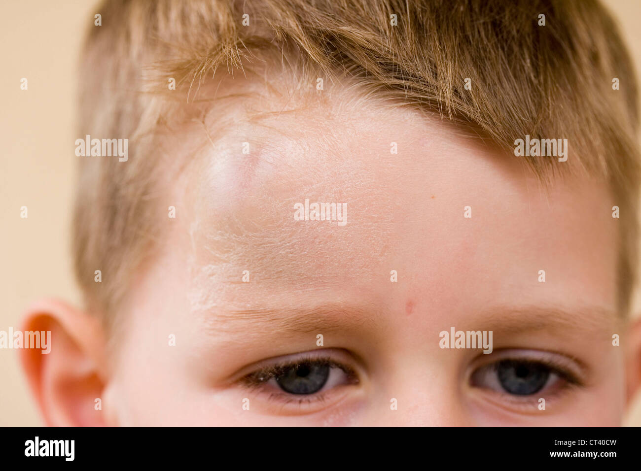 CHILD WITH HEMATOMA Stock Photo 49260649 Alamy