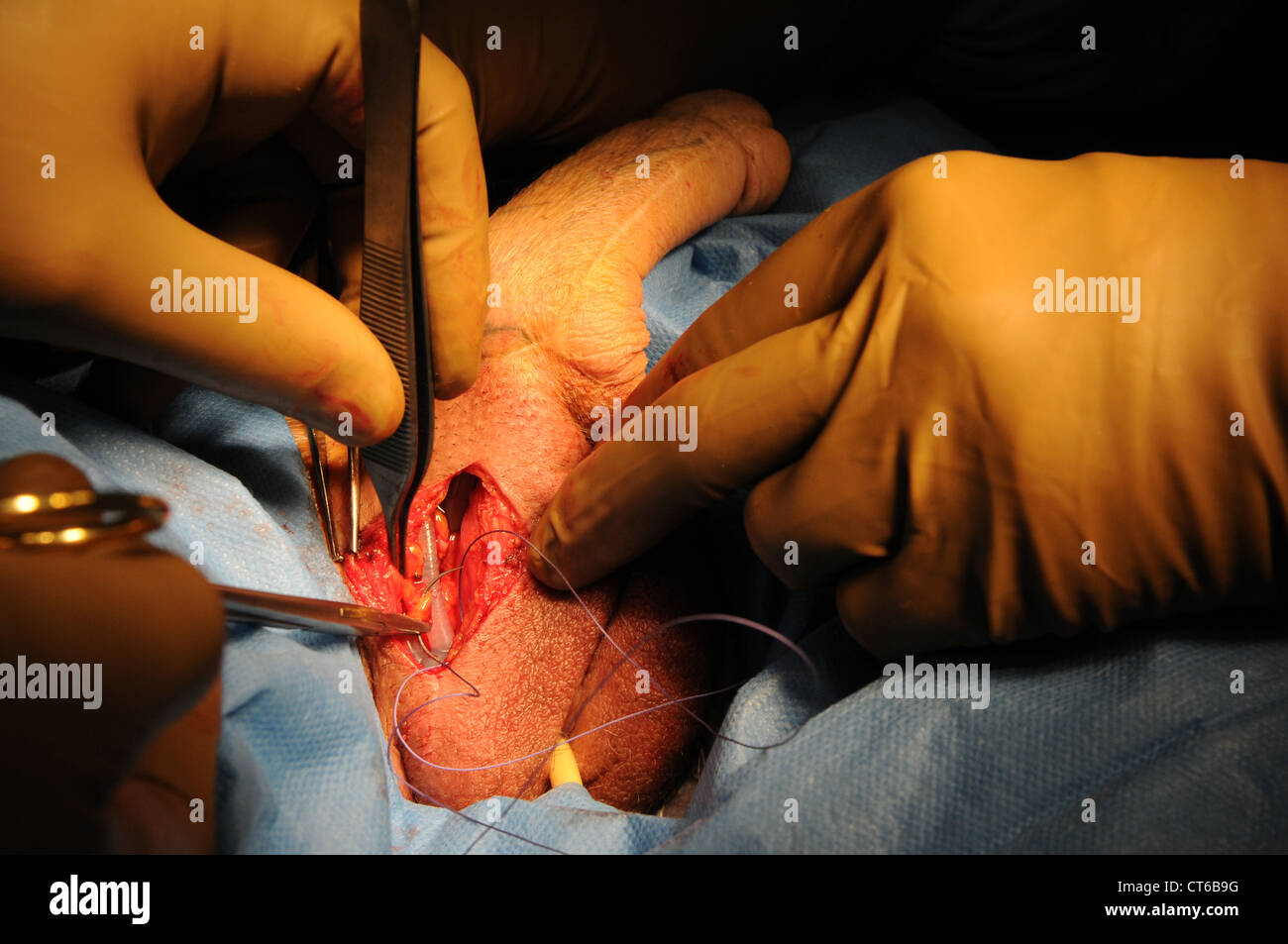 PHALLOPLASTY Stock Photo, Royalty Free Image: 49313084 - Alamy PHALLOPLASTY Stock Photo, Royalty Free Image: 49313084 - Alamy