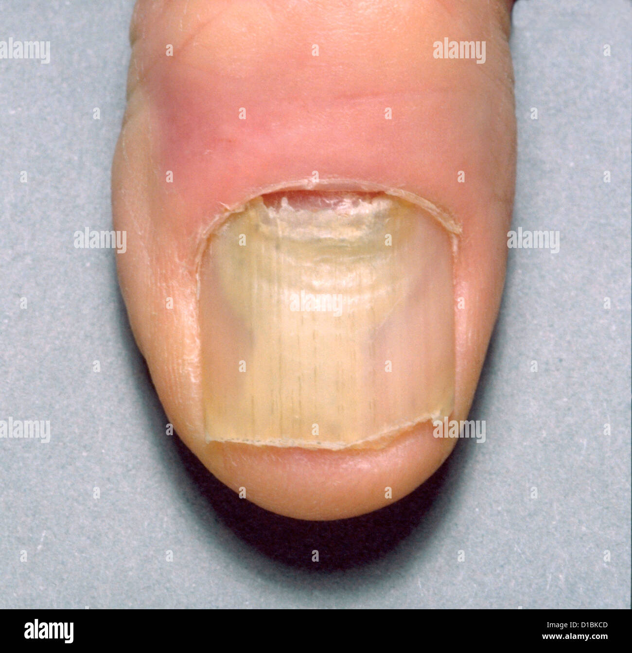 NAIL DYSTROPHY Stock Photo 52502477 Alamy
