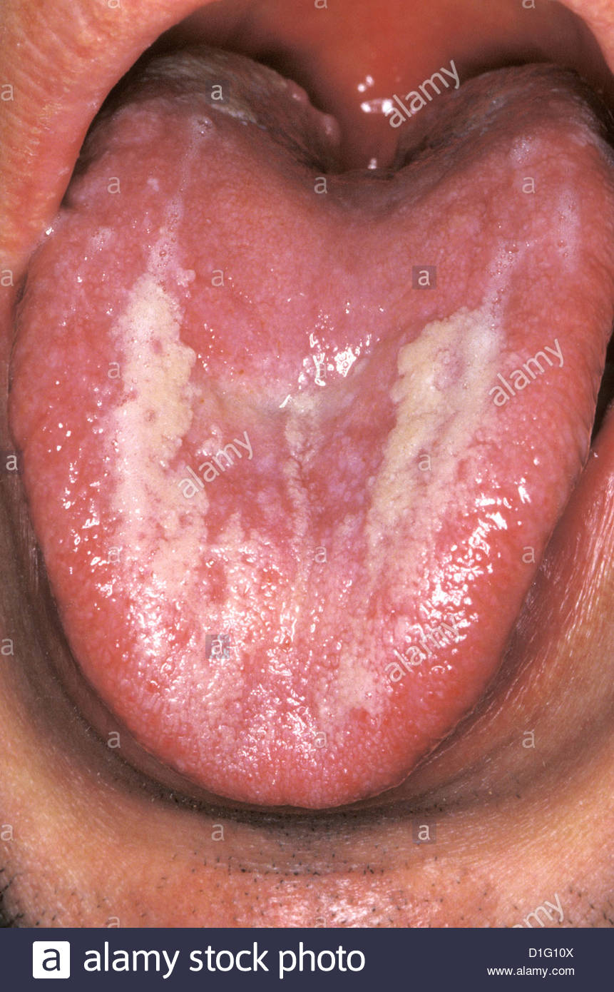Hairy Leukoplakia Of Tongue 43