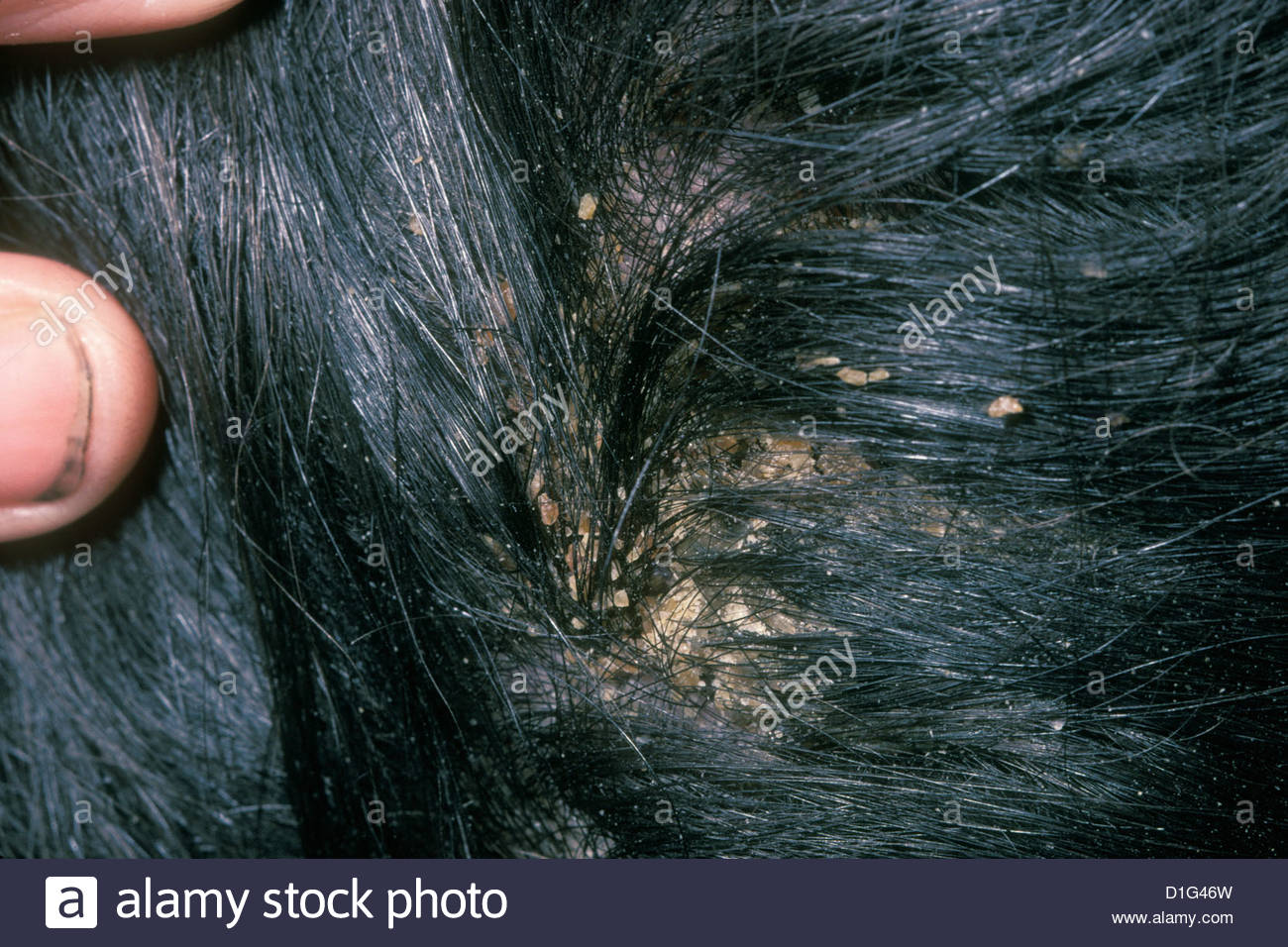 What do lice and nits look like in the hair?