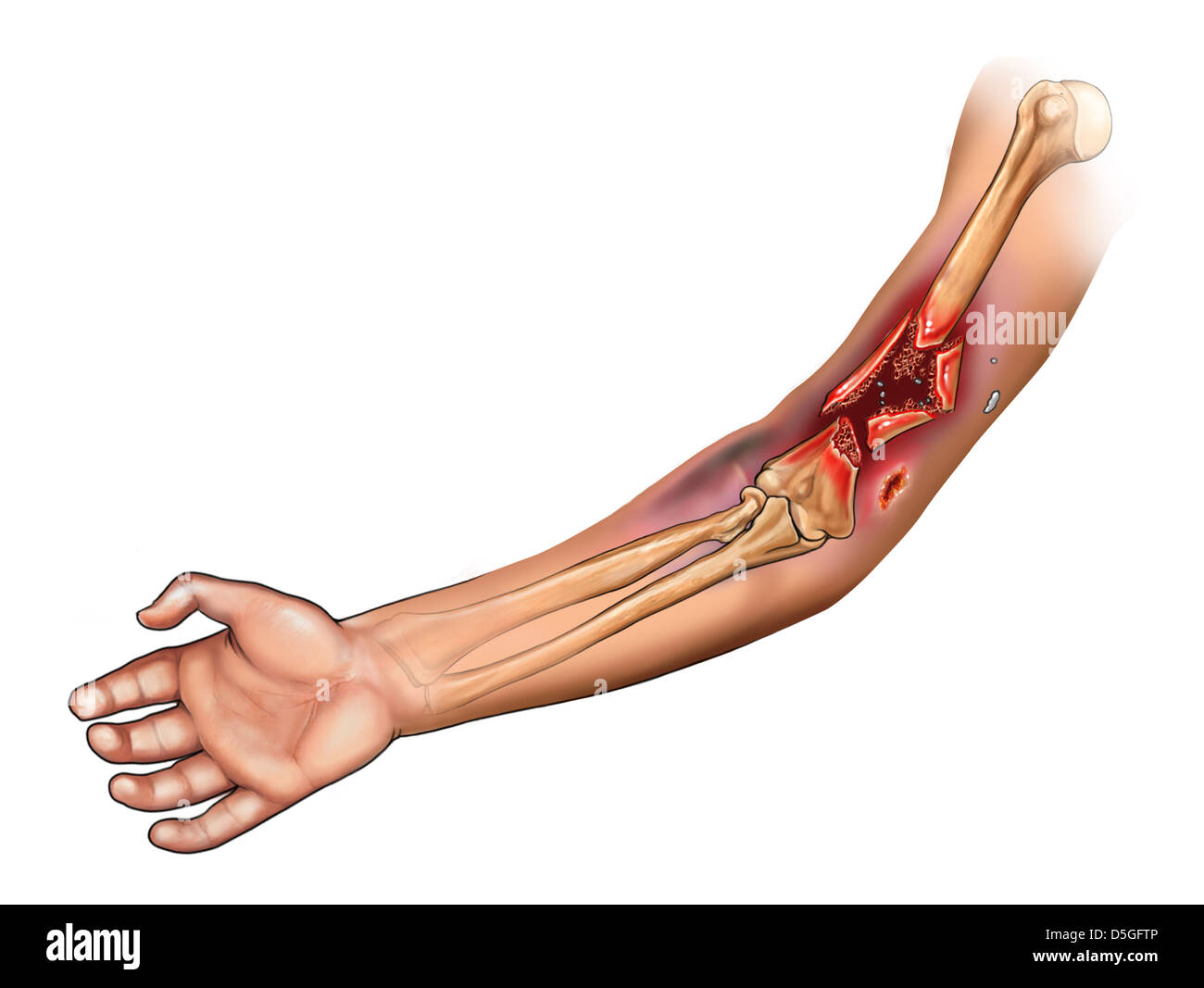 Humerus Fracture Hi Res Stock Photography And Images Alamy