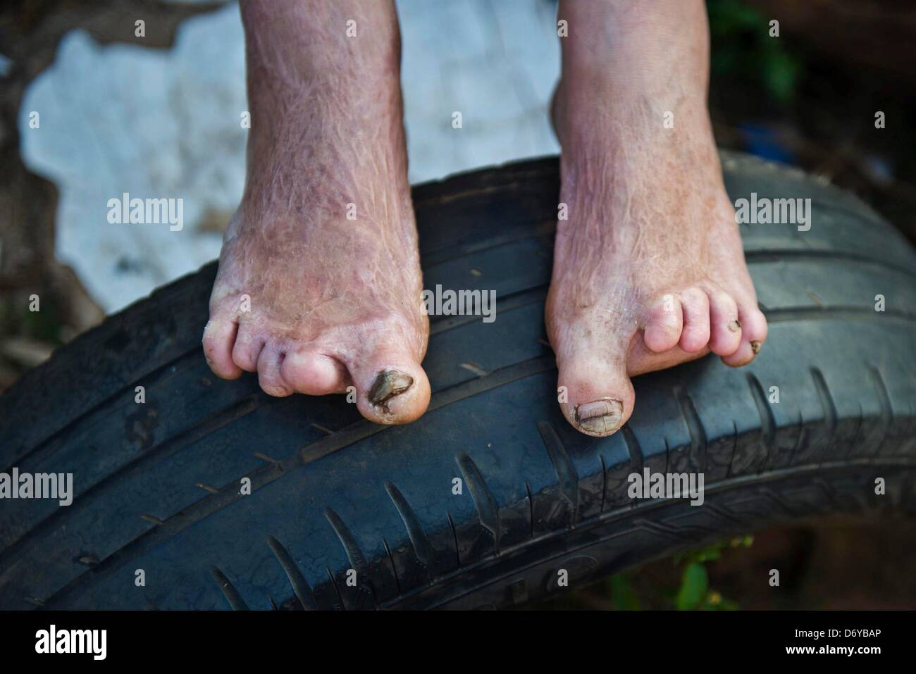 JOHANNESBURG, SOUTH AFRICA Irene van Niekerk's burnt feet on April