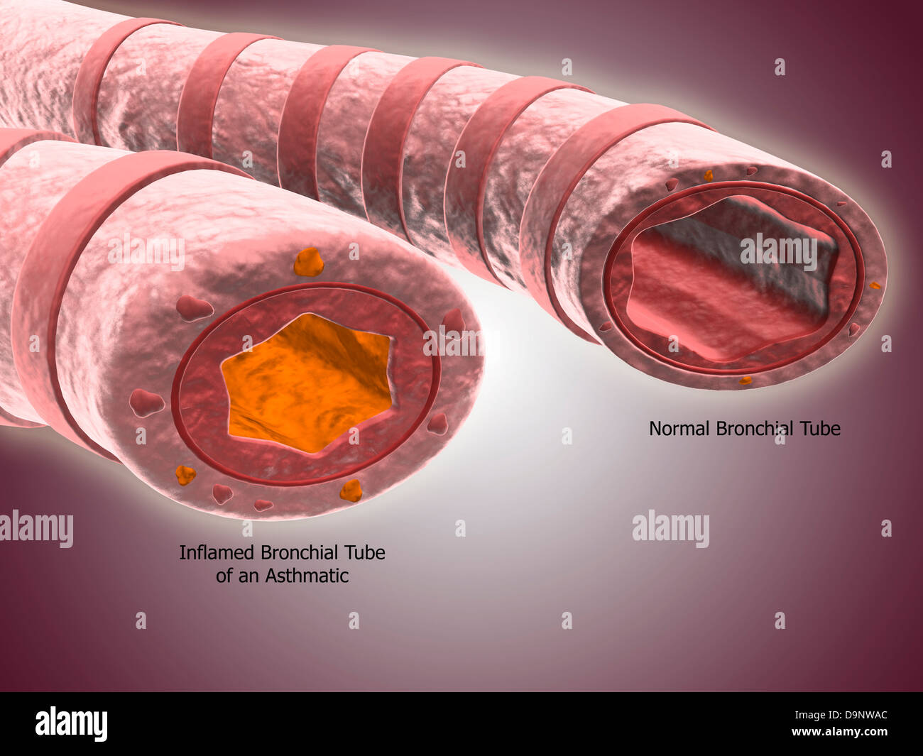 Trachea crosssection showing comparison of normal and asthmatic Stock