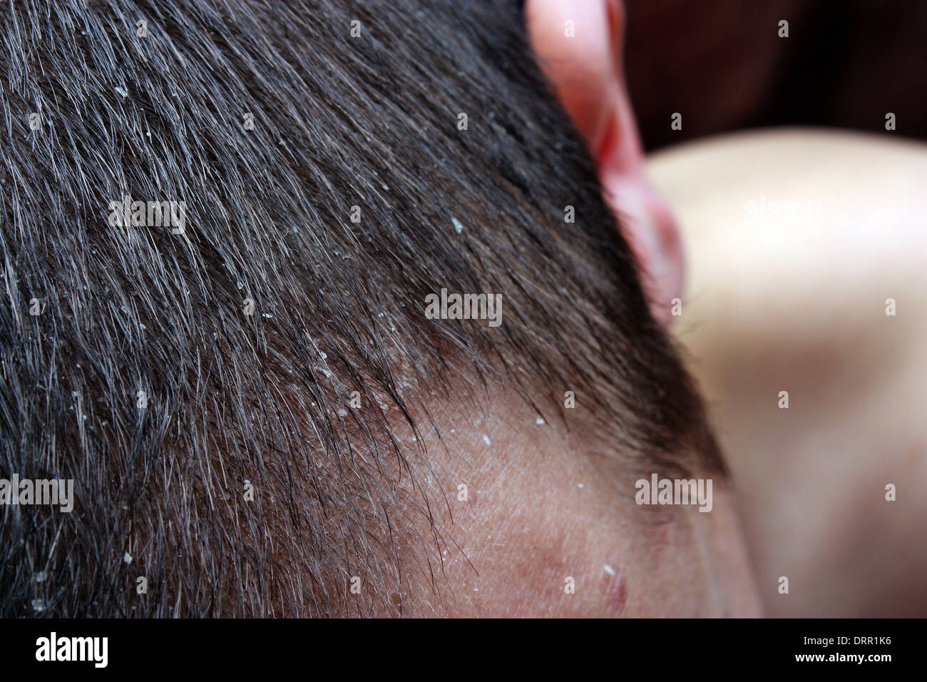 Dandruff In The Hair Symptoms Of Skin Disease Stock Photo