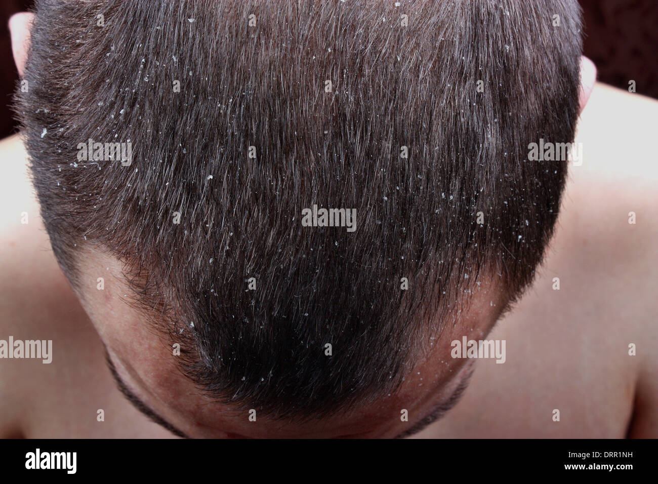 Symptoms Of The Disease Psoriasis In Hair Stock Photo 66274477