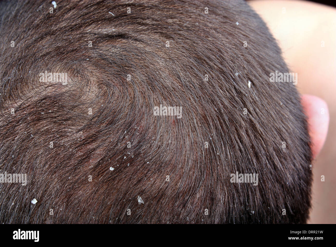 The Symptoms Of Psoriasis Scalp In The Hair Stock Photo 66274709 The Symptoms Of Psoriasis Scalp In The Hair Stock Photo 66274709