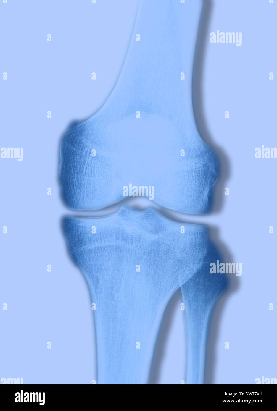 Tibia X Ray Cut Out Stock Images Pictures Alamy