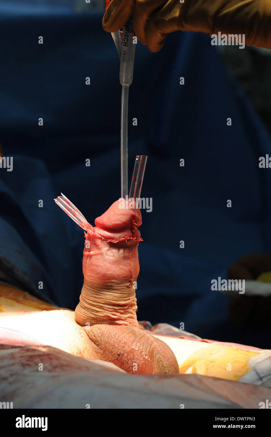 Penis Surgery Photos 9