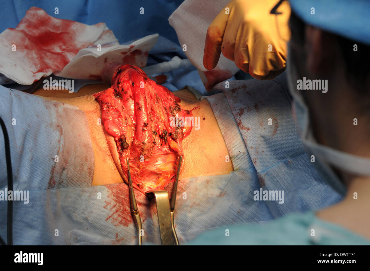 vagina surgery photos dean trout sex