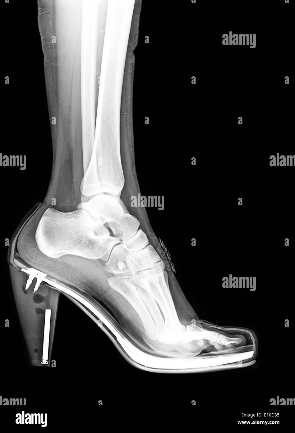 x-ray-of-a-foot-and-ankle-in-a-high-heel
