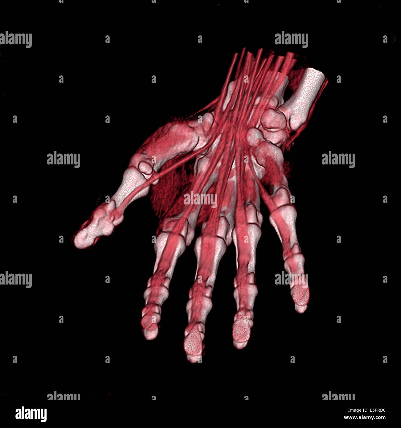 3D computed tomographic (CT) scan reconstruction of the left hand Stock