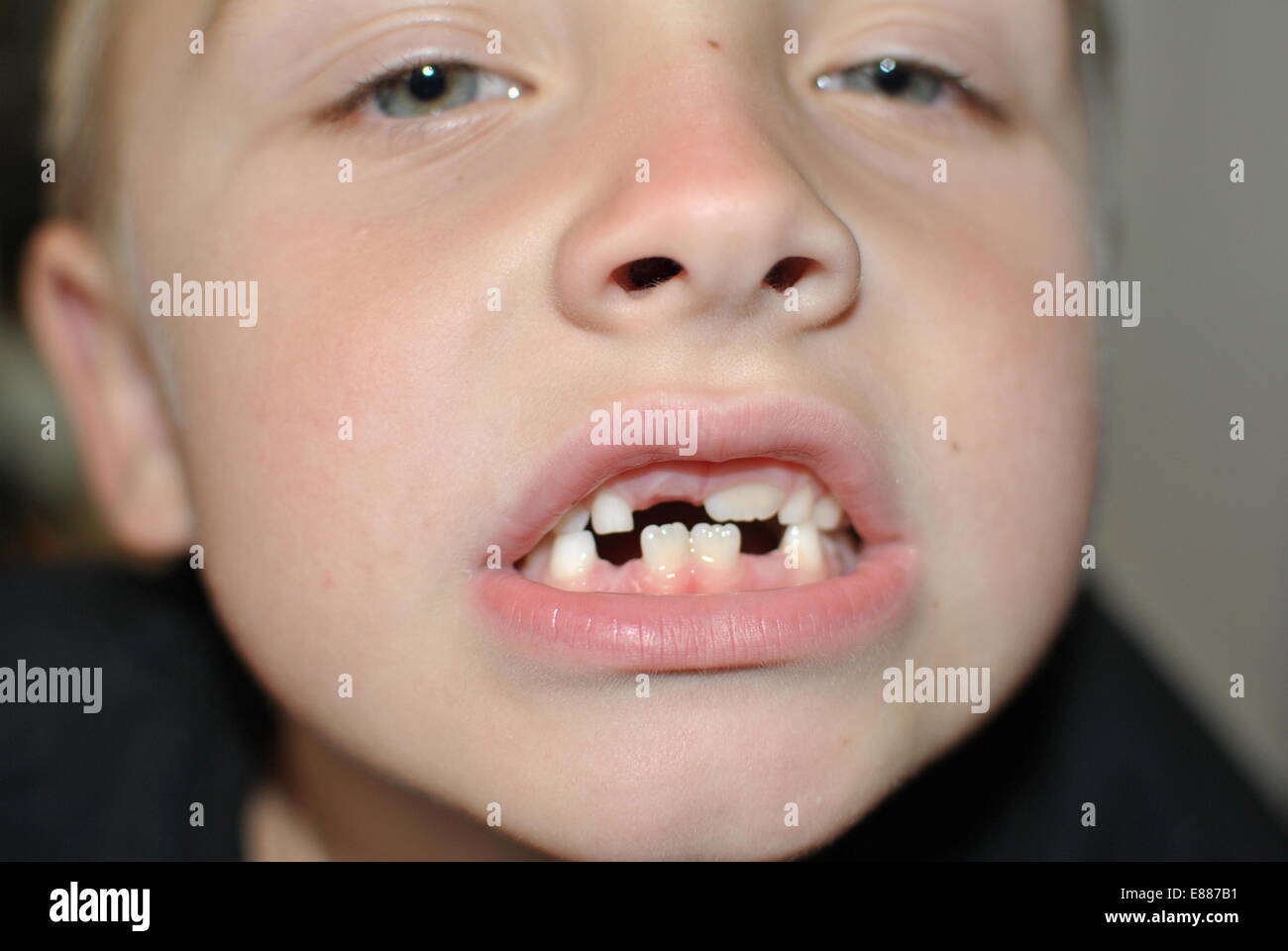 Milk Teeth High Resolution Stock Photography And Images Alamy