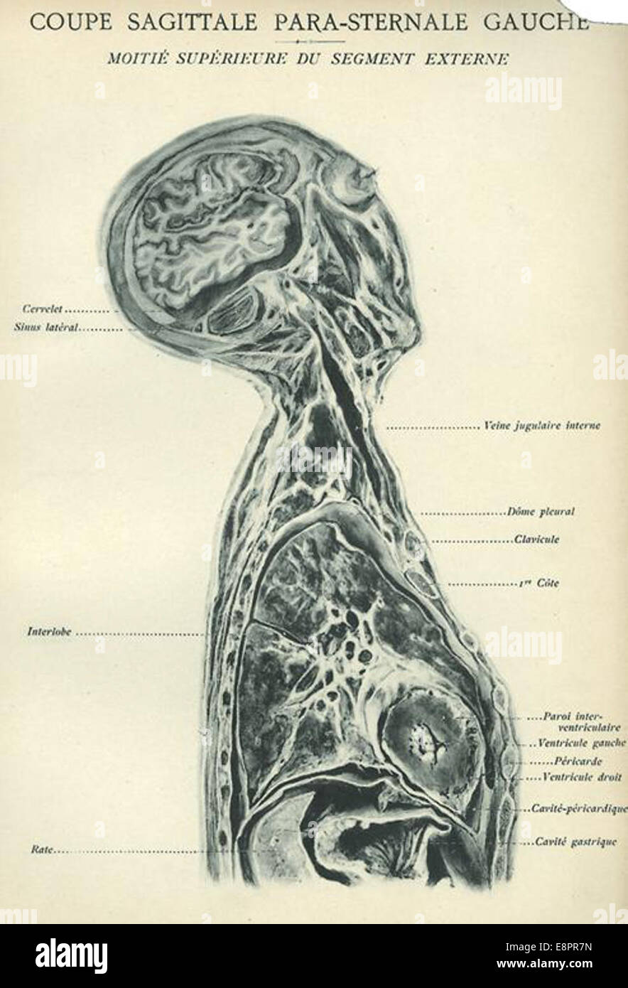Coupe Sagittale Para Sternale Gauche Moiti Sup Rieure Du Segment