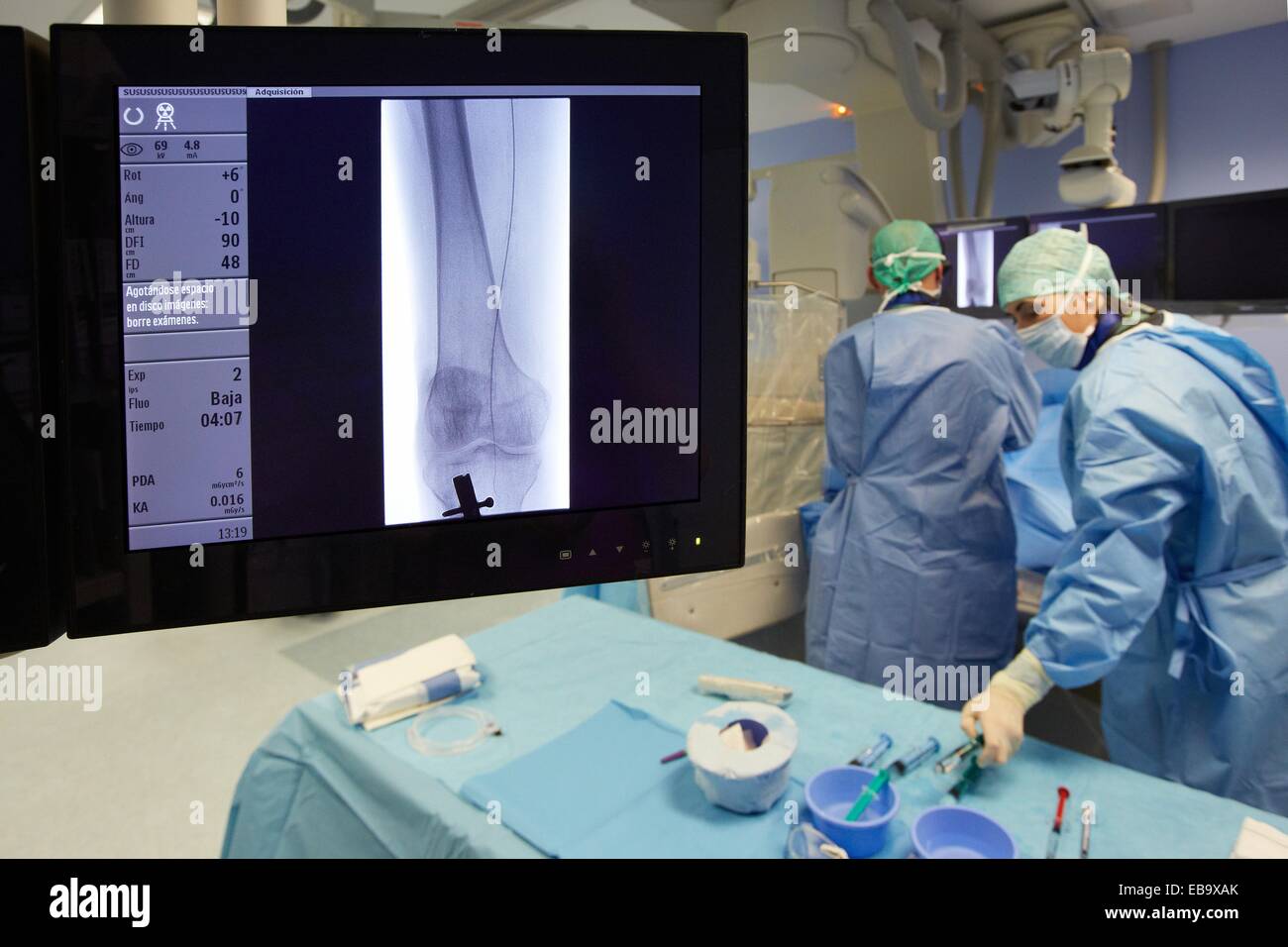 Angioplasty Distal, Vascular Interventional Radiology, Operating Stock