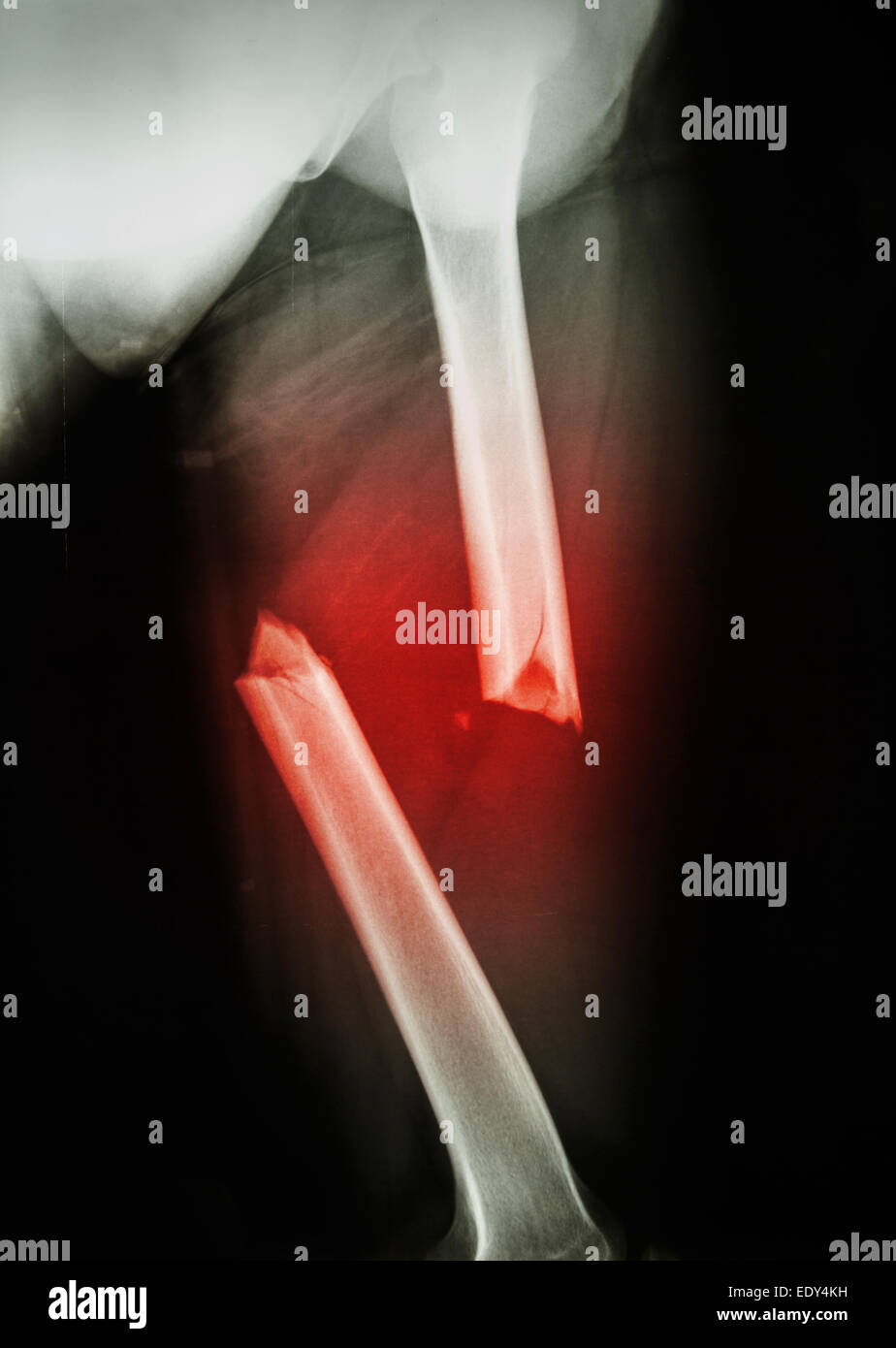 Film X Ray Left Femur Left Thigh Show Complete Fracture Shaft Of Femur