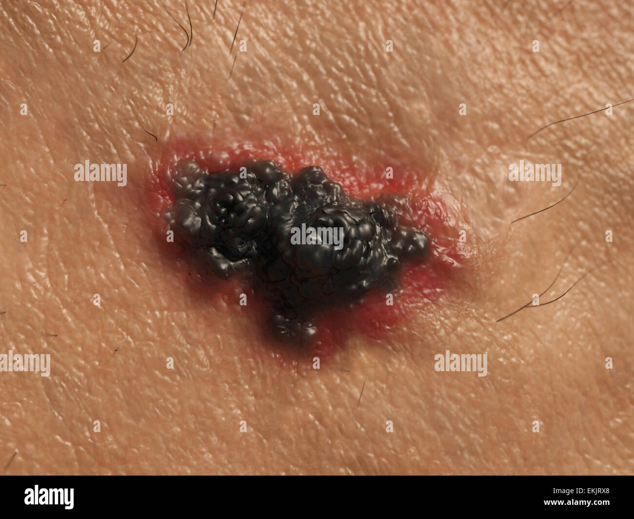 How do you find pictures of abnormal skin moles?