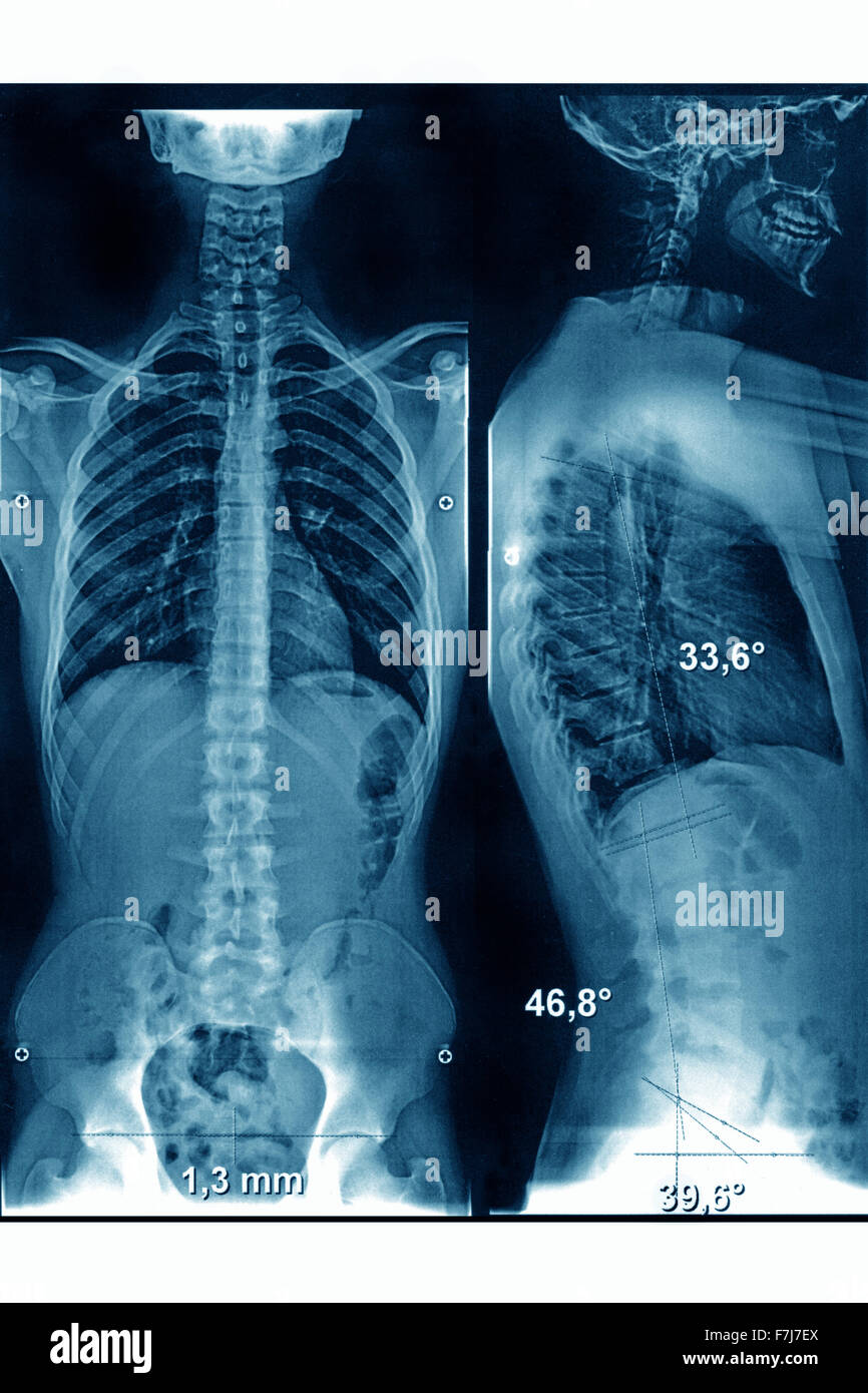 SPINAL COLUMN X RAY Stock Photo Royalty Free Image 90755474 Alamy