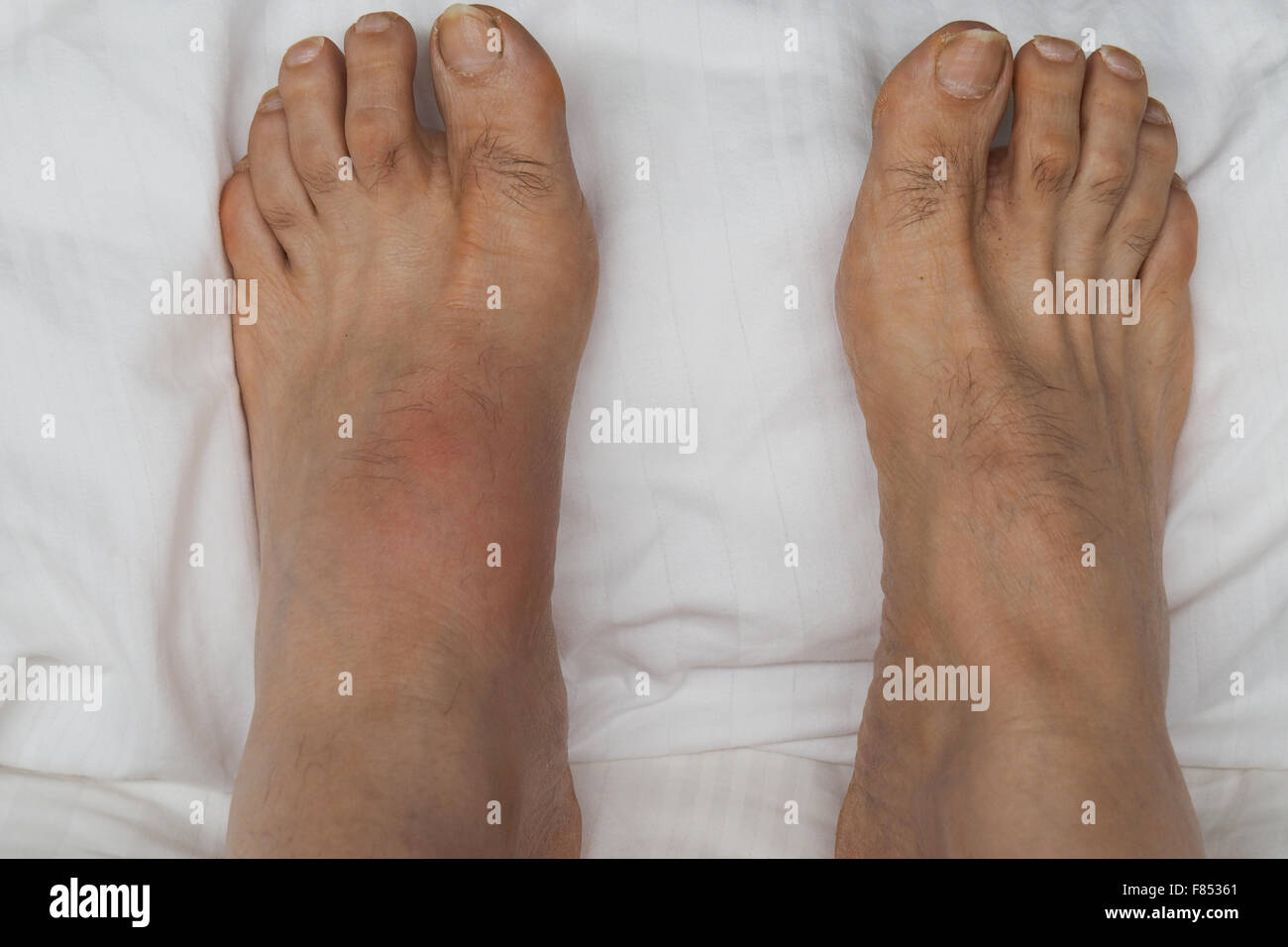 Inflamed Swollen Feet 46