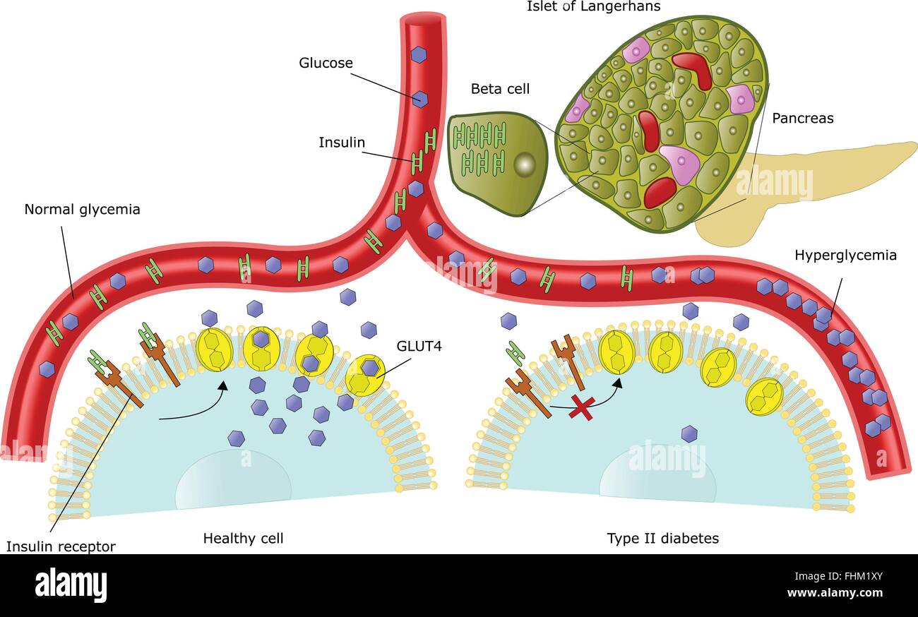 diabetes schematic description of insulin resistance in type II Stock