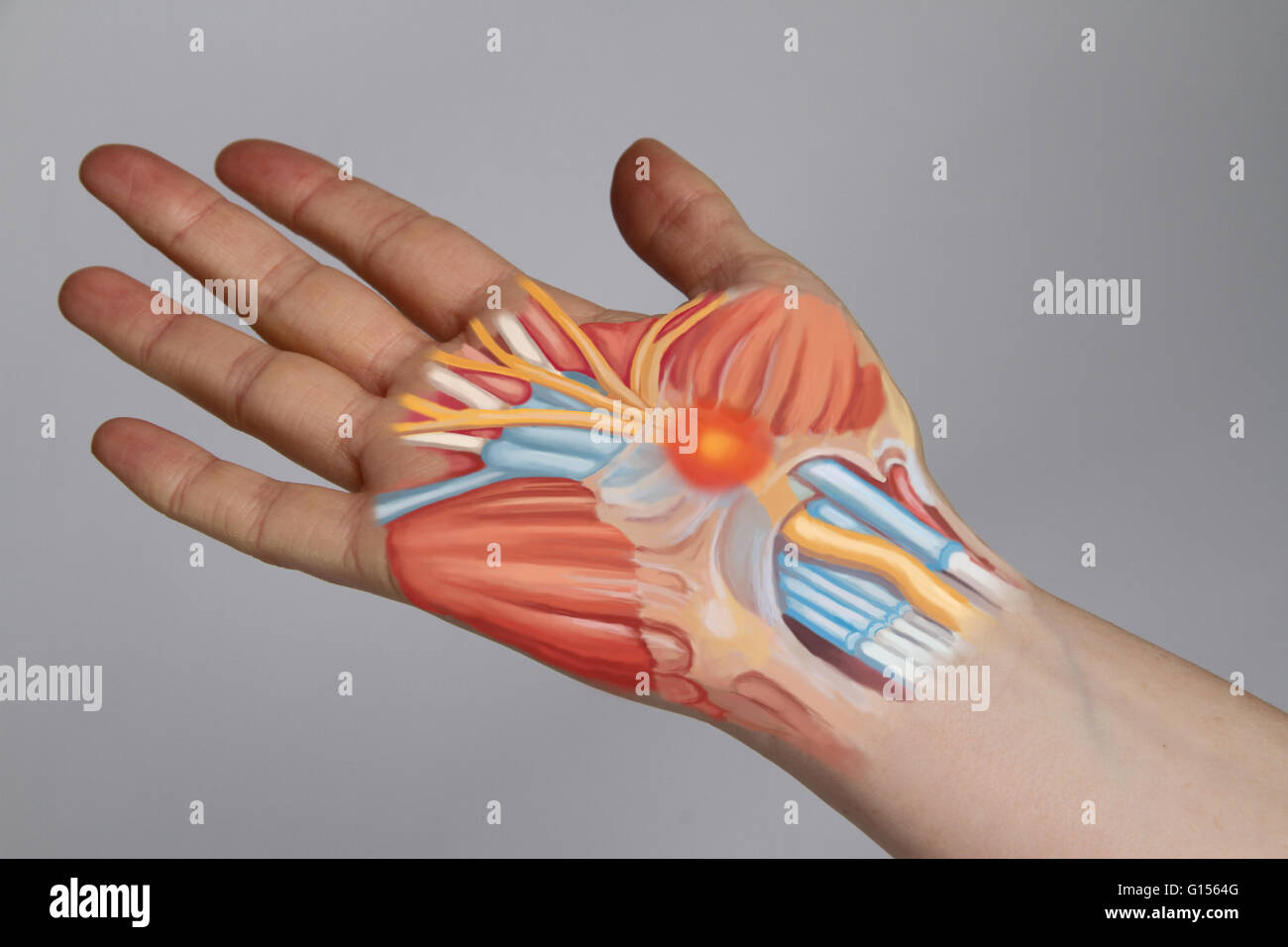 Carpal tunnel syndrome (CTS) is a compression of the median nerve Stock Photo, Royalty Free