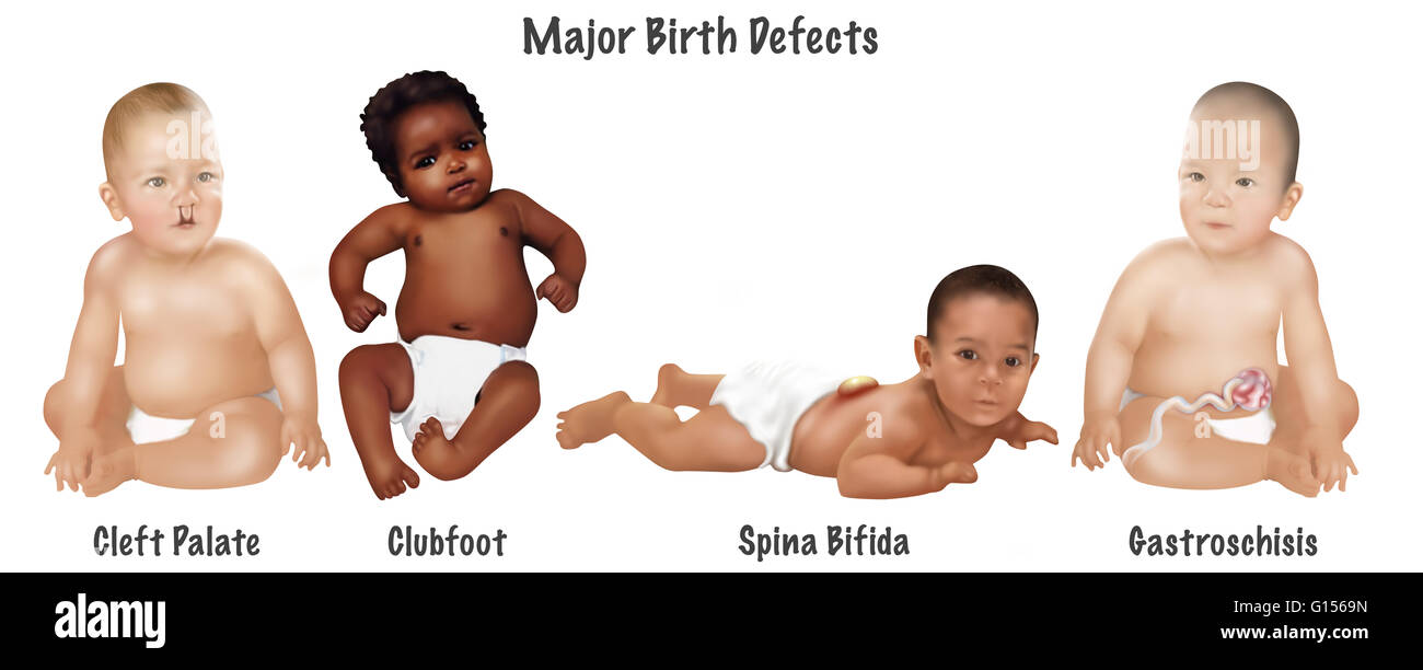 An illustration of 4 common birth defects found in babies ...