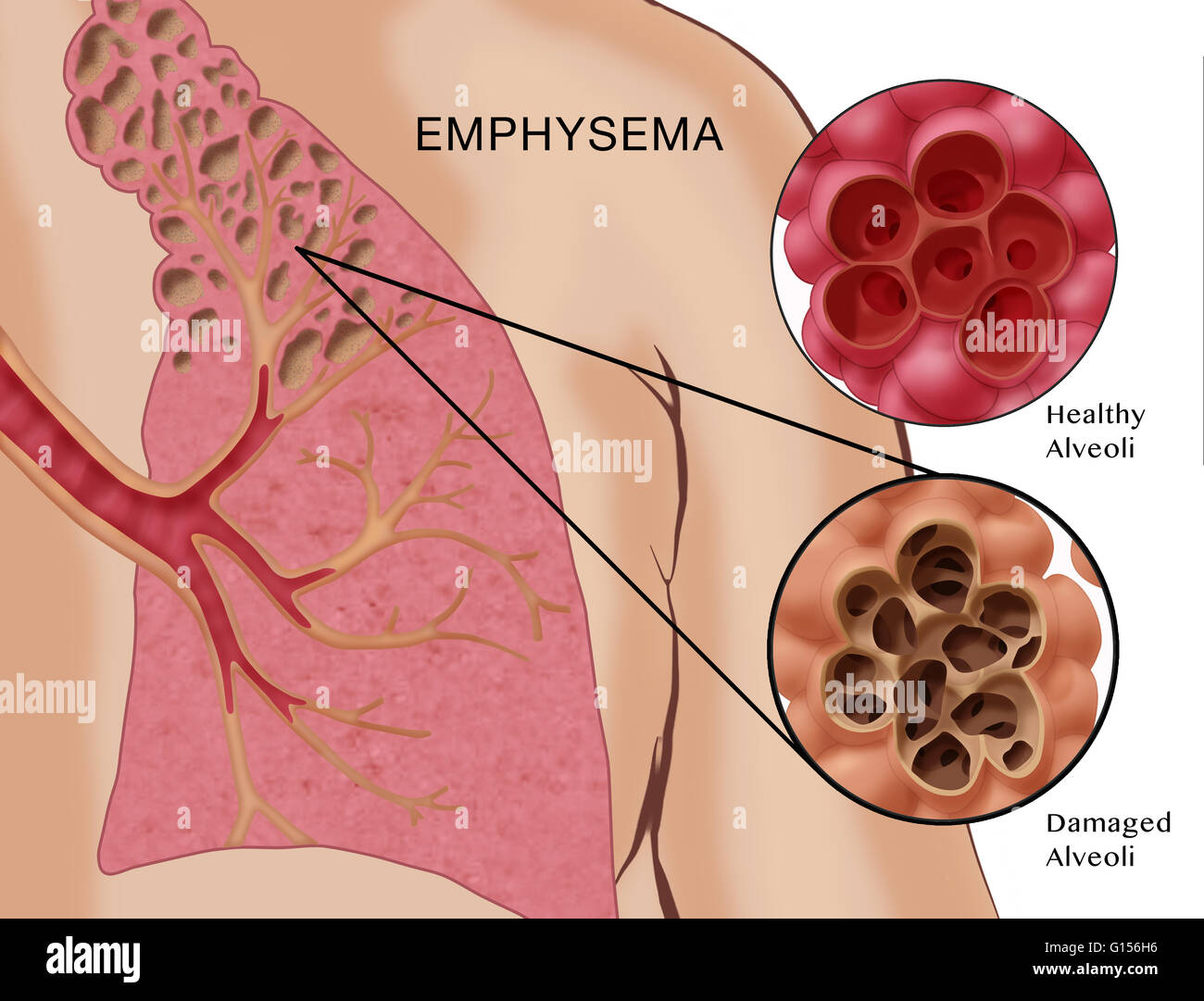 Accutane Damages Lung