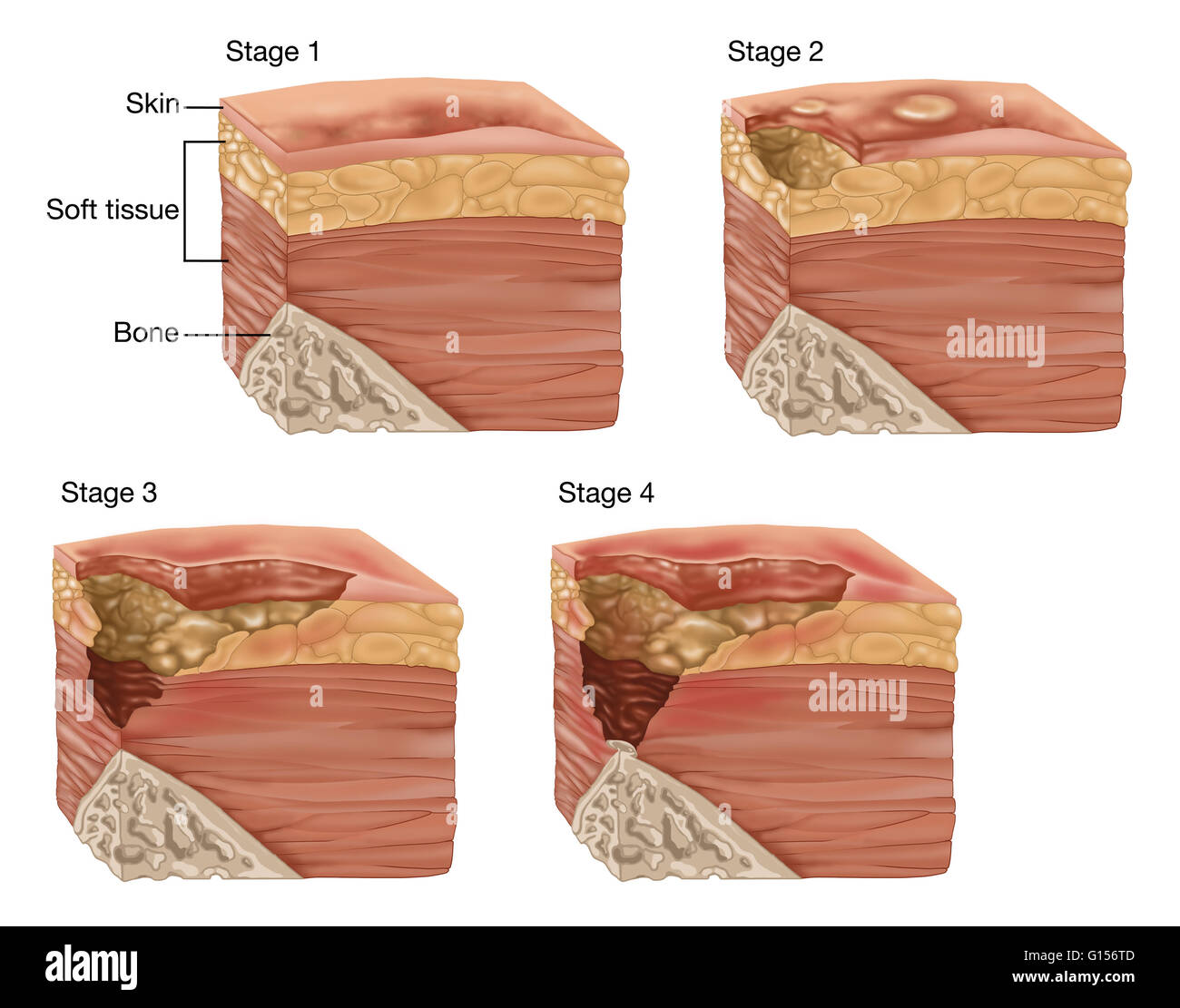 Bed Sores Treatment Stages And Prevention Pressure Ul Vrogue Co