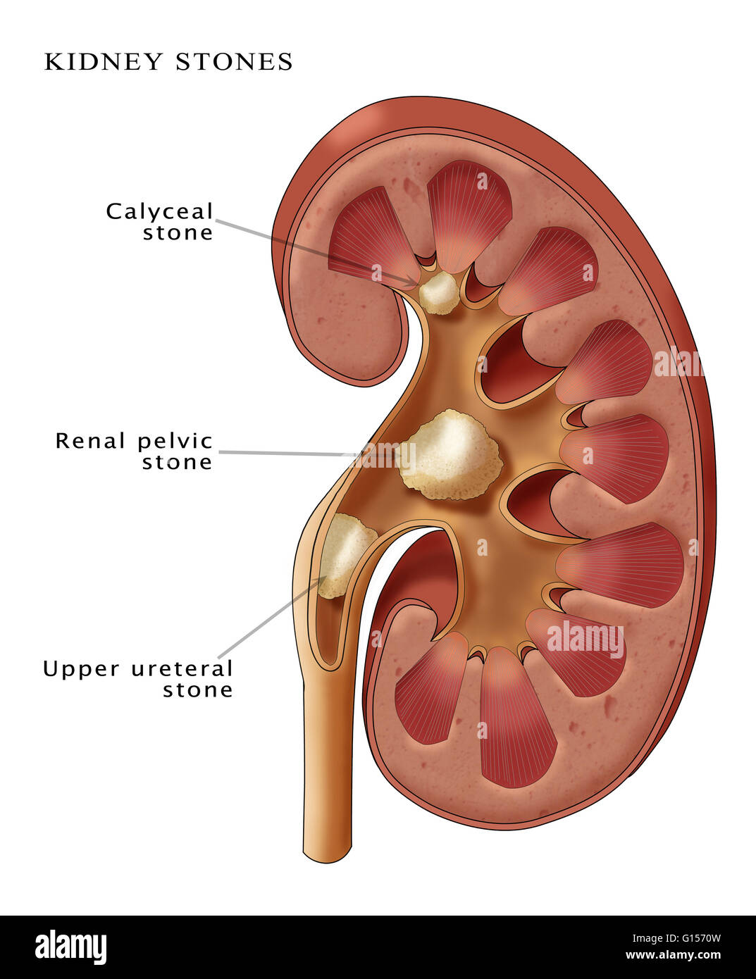 Free trial the kidney stone removal report kidneystoneremedy com.