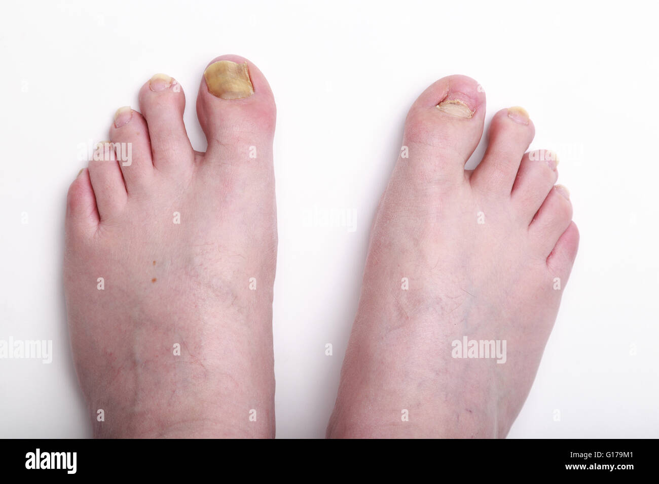 40 Year old caucasian man's feet showing missing toenail and Stock
