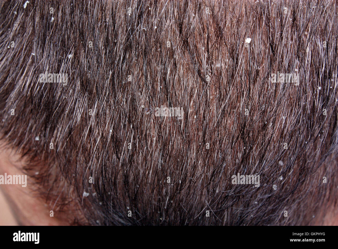 Dandruff In The Hair Symptoms Of Skin Disease Stock Photo